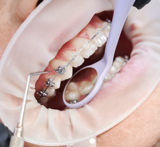 Close up of orthodontist using cofferdam and dental instruments while placing orthodontic brackets on patient teeth. Concept of stomatology, dentistry and orthodontic treatment.