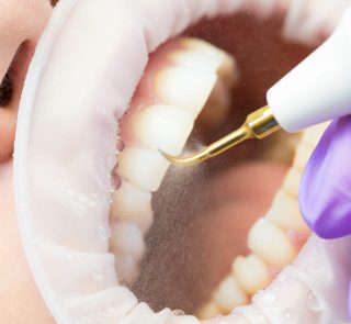 Ultrasonic,Teeth,Cleaning,,Close-up.,Removal,Of,Tartar,,Plaque.,Paradontitis,,Paradantoz.